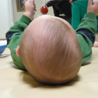 kreiva kūdikio galvytė; plagiocefalija; plokščios galvos sindromas