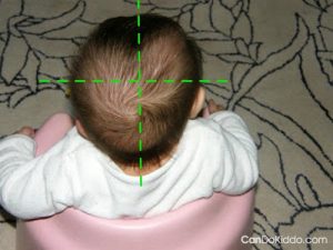 kreiva kūdikio galvytė; plagiocefalija, nugulėta viena pusė
