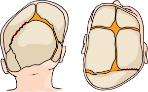 kraniosinostoze; kaukoles kaulu deformacija; kudikio kaukole