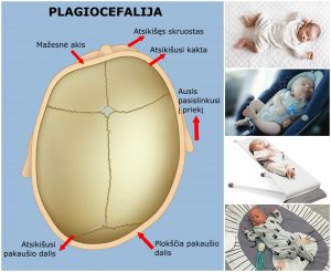 Plagiocefalija, kreiva galvyte, nuguleta galvyte