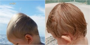 plagiocefalija; nuguleta galvyte