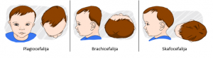 plagiocefalija; brachicefalija