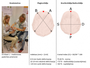 plagiocefalija; kraniometras
